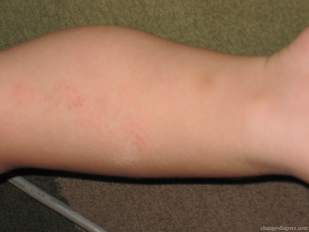 Eczema and Your Skin - WebMD