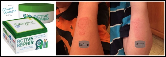 Babytime by @Episencial Active Repair eczema cream beforeafter via @chgdiapers