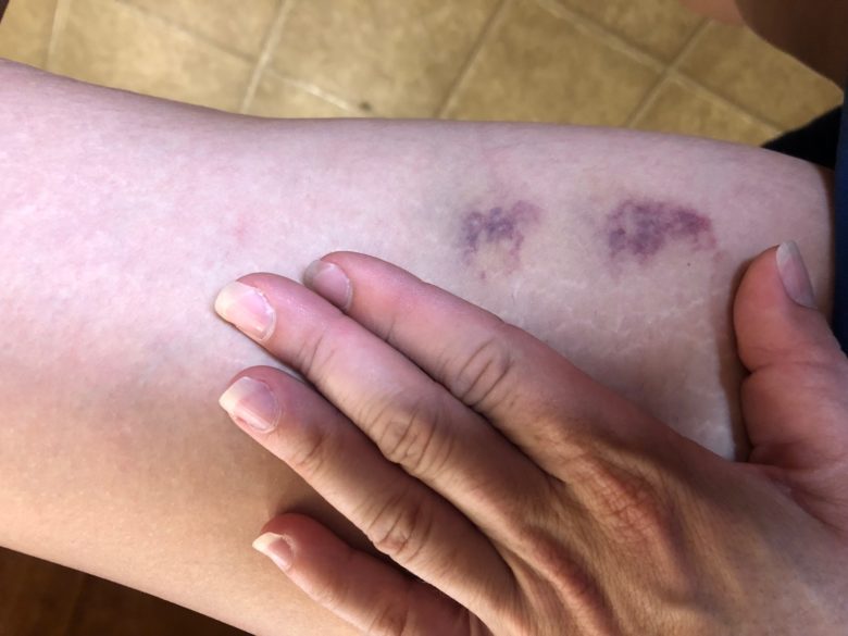 Does Arnica Really Work on Bruises?